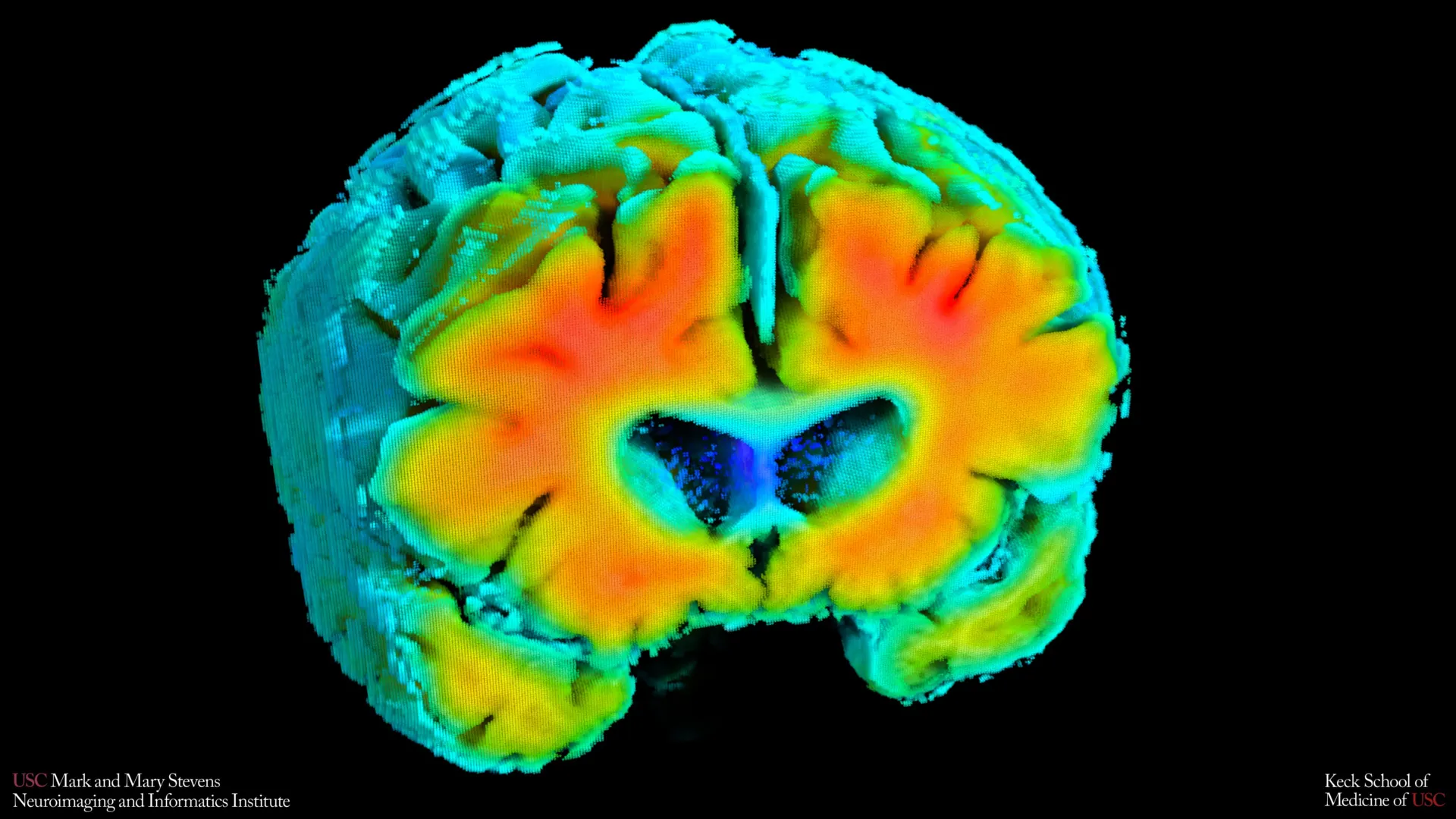 Brain Blood Flow Linked to Alzheimer’s