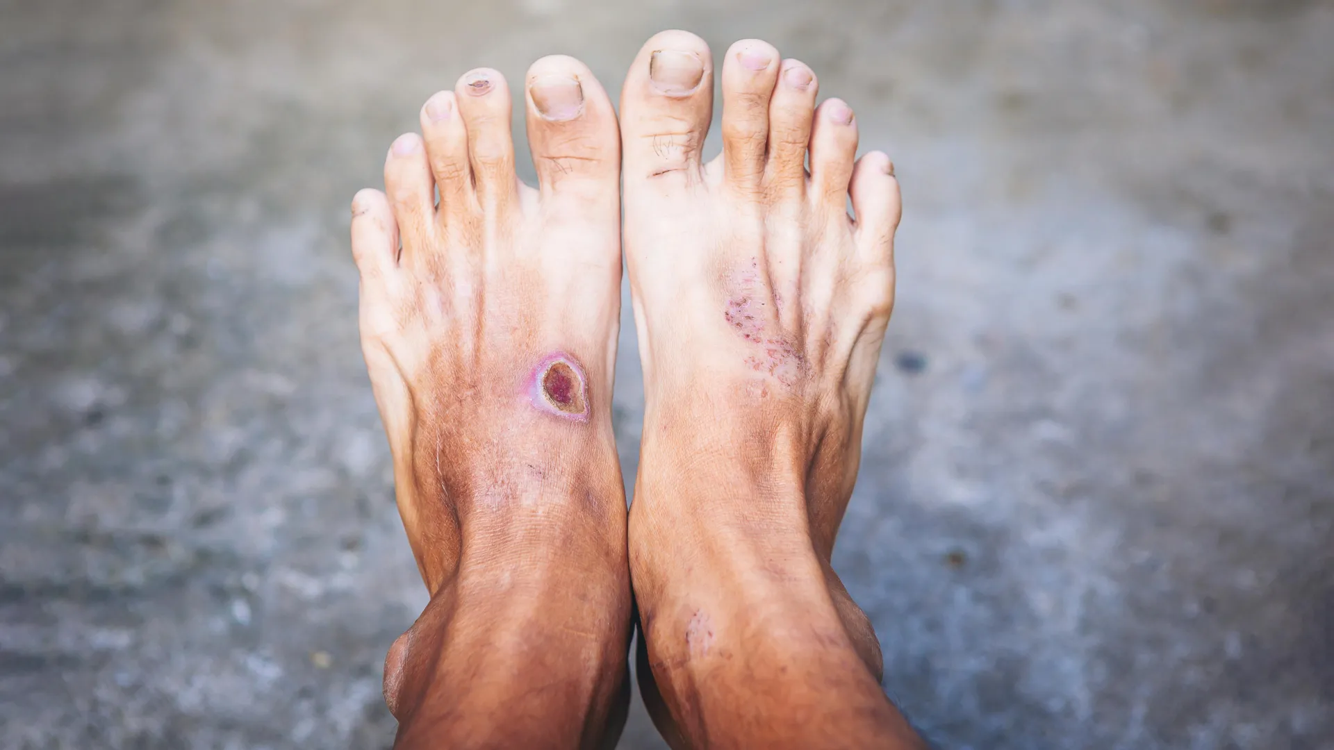 The Hidden Threat in Diabetic Foot Infections