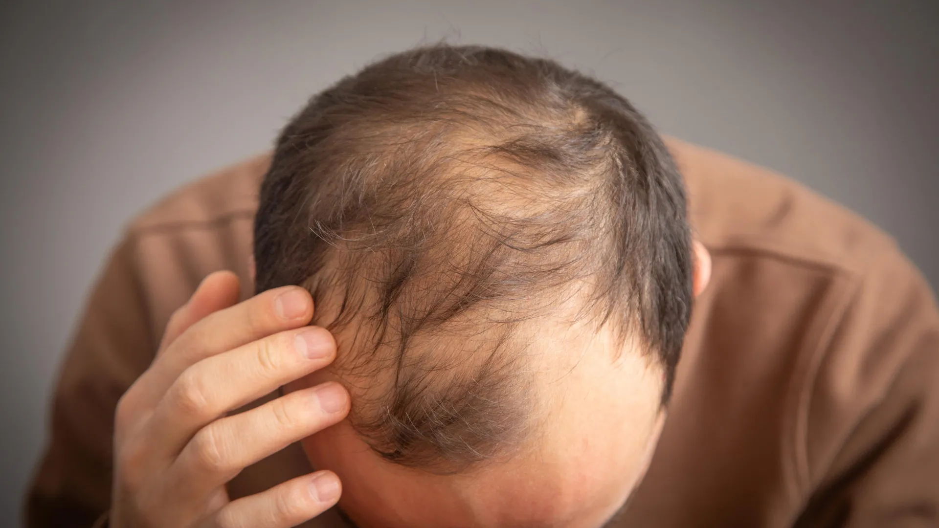 Ozempic May Raise Hair Loss Risk in Men