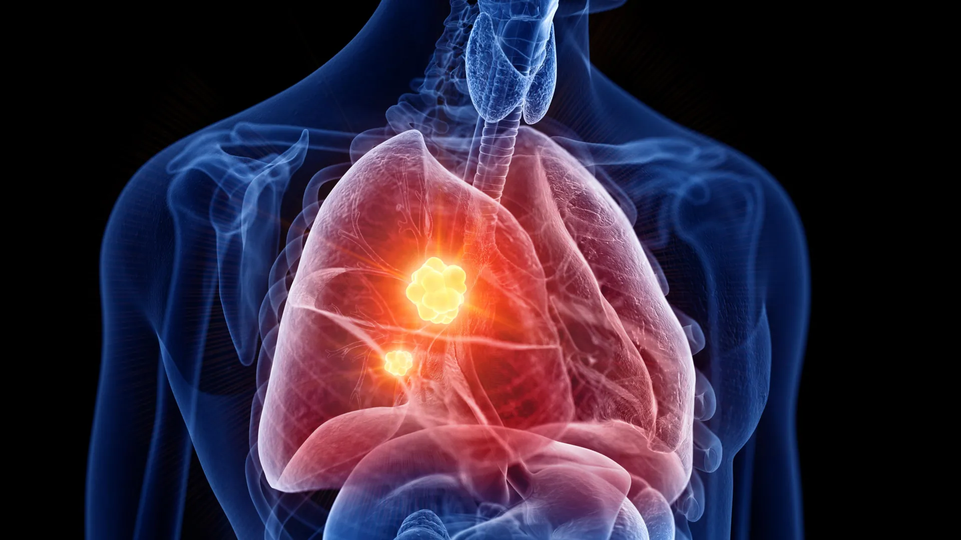 New mesothelioma drug turns cancer’s own defenses against it