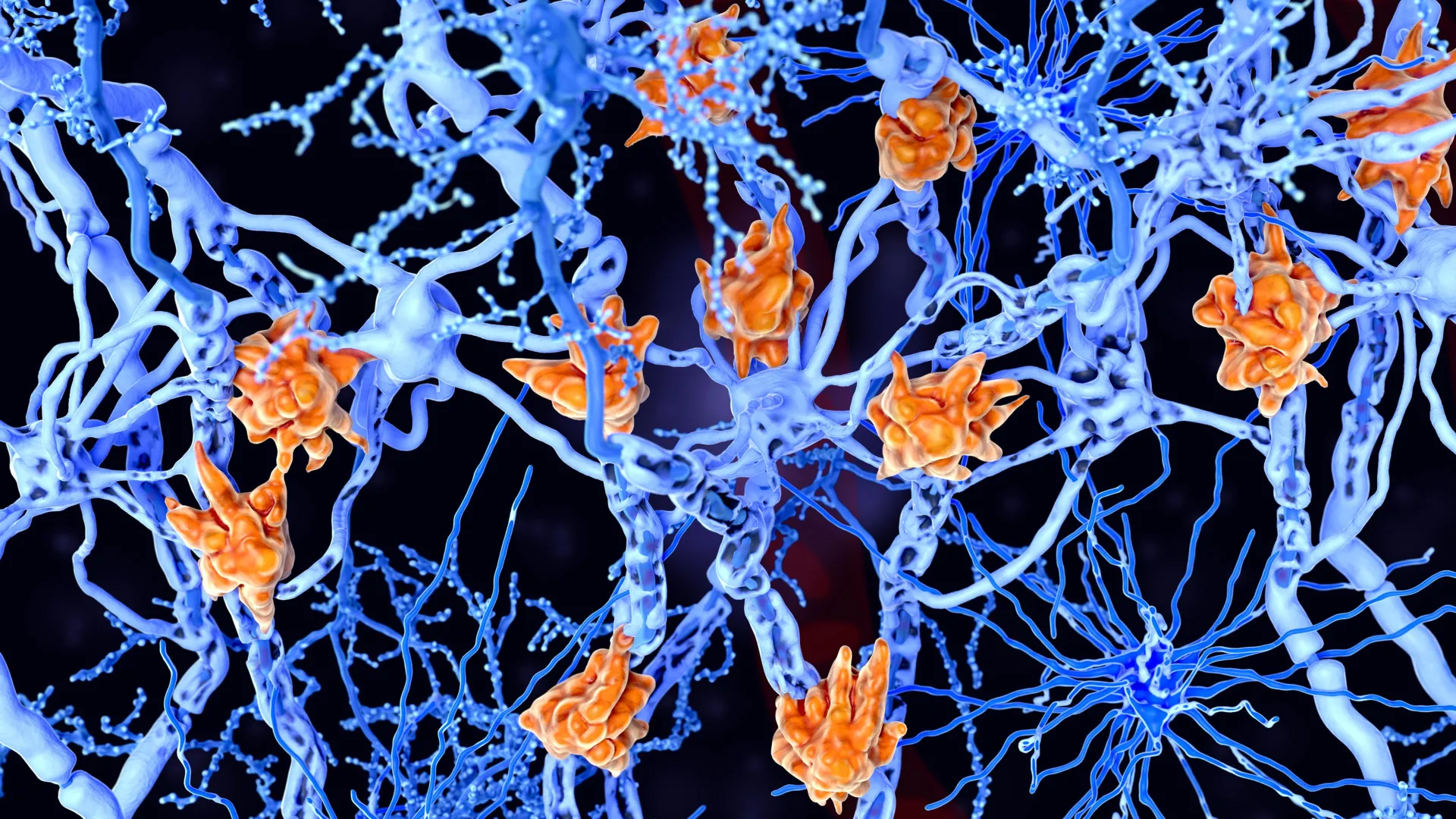 New Clue to Severe Multiple Sclerosis