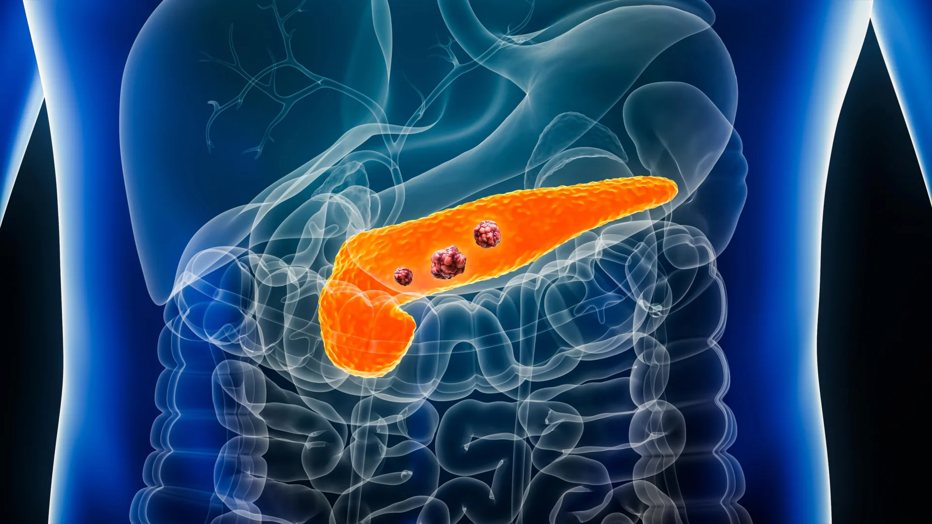 AI Detects Pancreatic Cancer Years Early