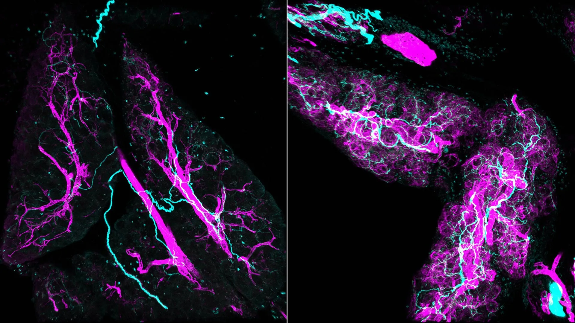 Scientists Find Nerves Actively Fuel Pancreatic Cancer