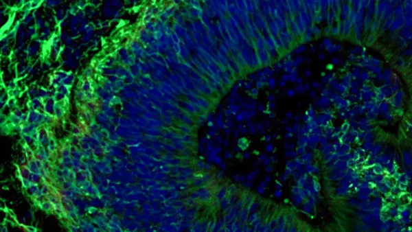 Mini Brains Expose Alzheimer’s Differences